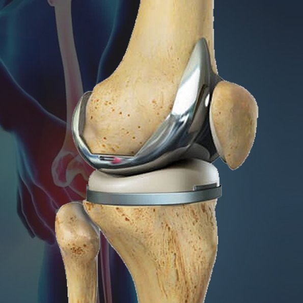 Knee-Replacement-Surgery-copy-1