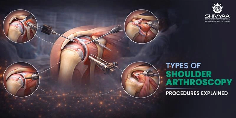 types of shoulder arthroscopy explained