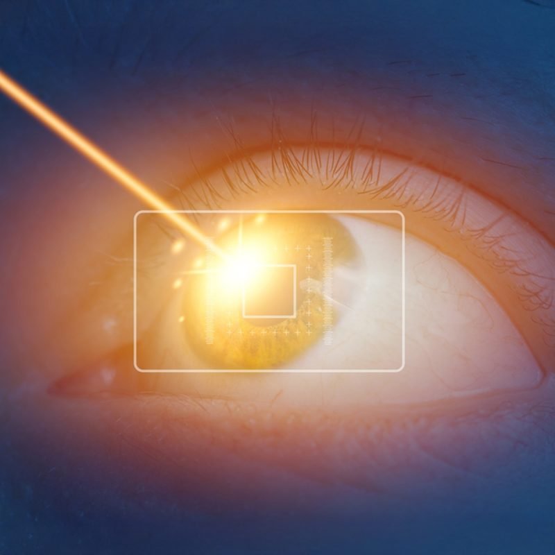 01 Refractive Surgery