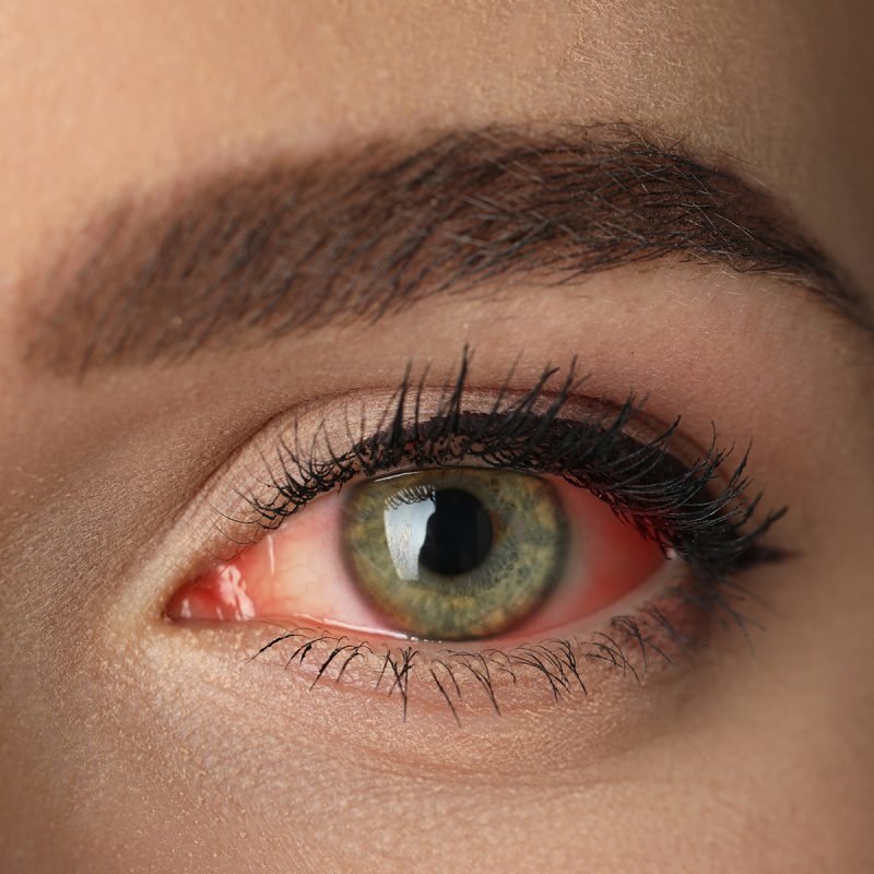 02 Signs & Symptoms of Scleritis