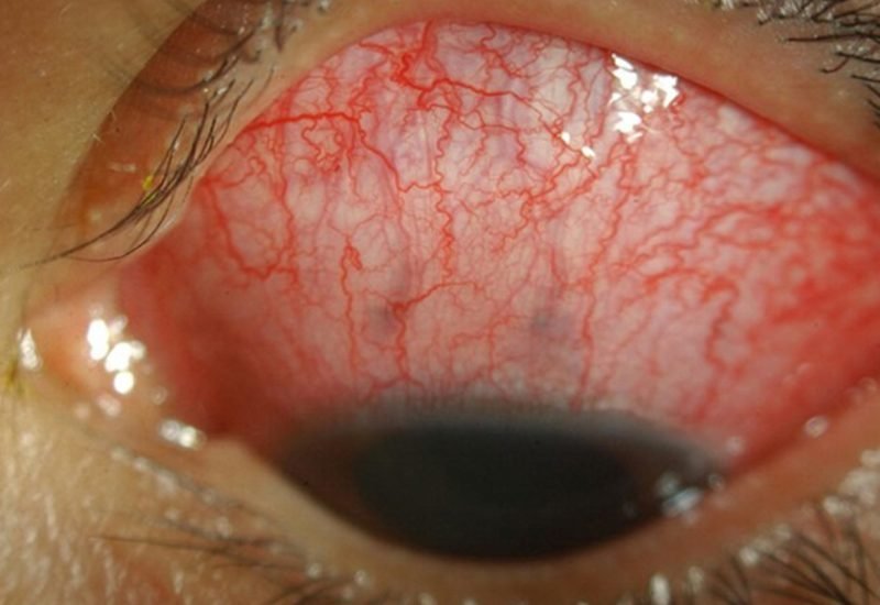 03 Anterior Scleritis