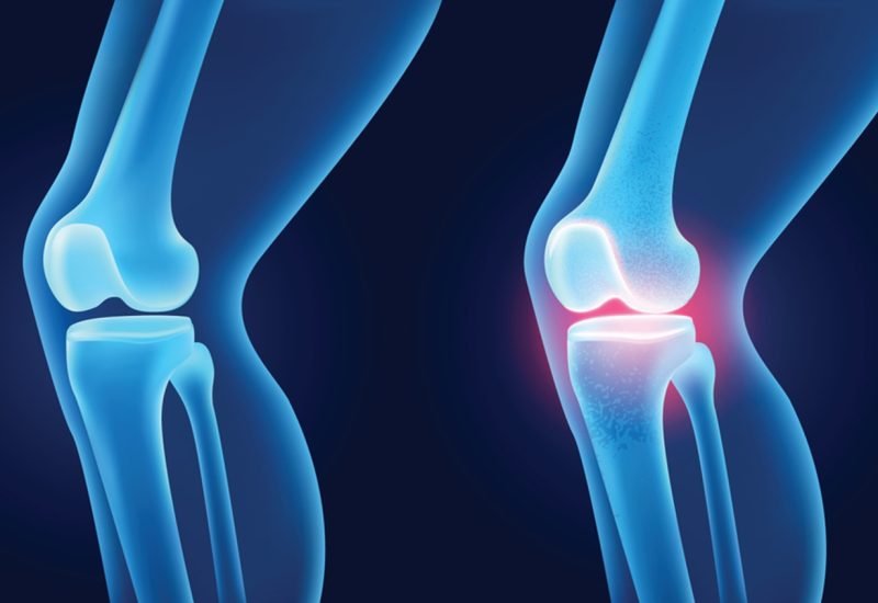 03 Cartilage Damage or Deformity