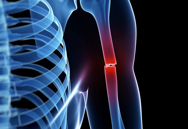 03 Orthopedic Trauma