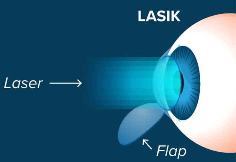 04 LASIK