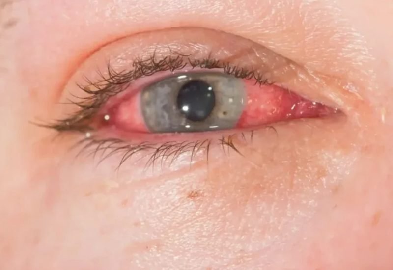 04 Posterior Scleritis