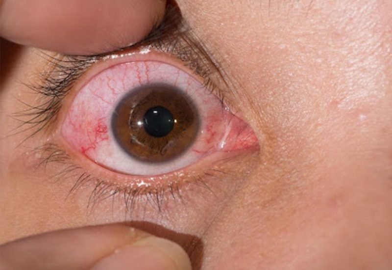 05 Diffuse Scleritis