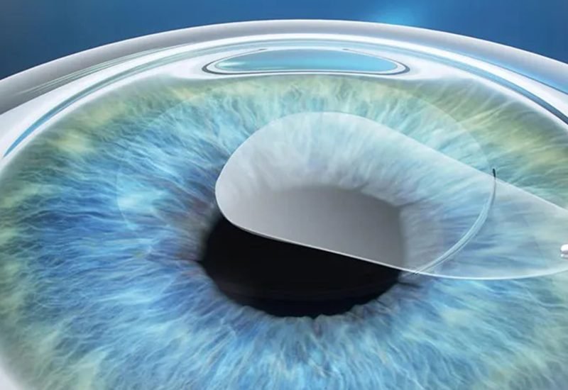 05 Refractive Lenticule Extraction
