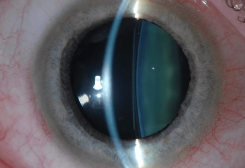 06 Implantable Collamer Lens
