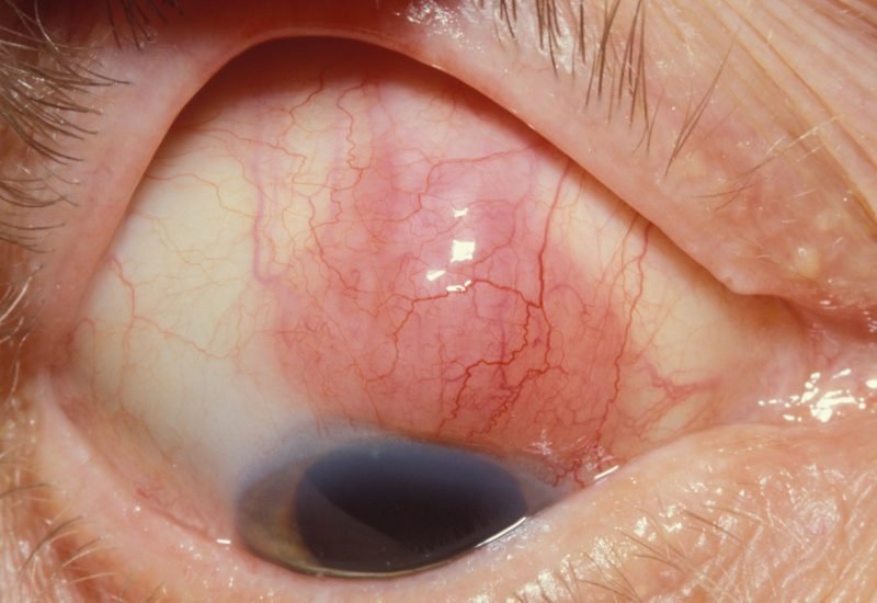 06 Nodular Scleritis