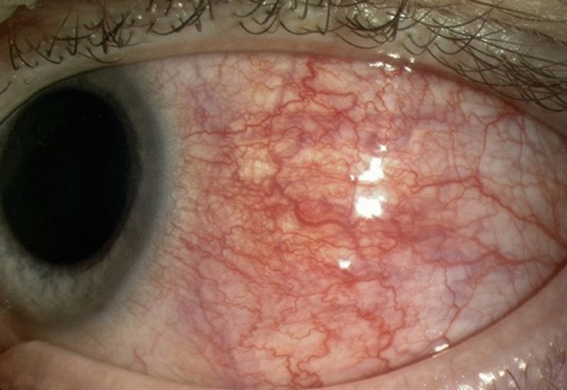 07 Necrotizing Scleritis