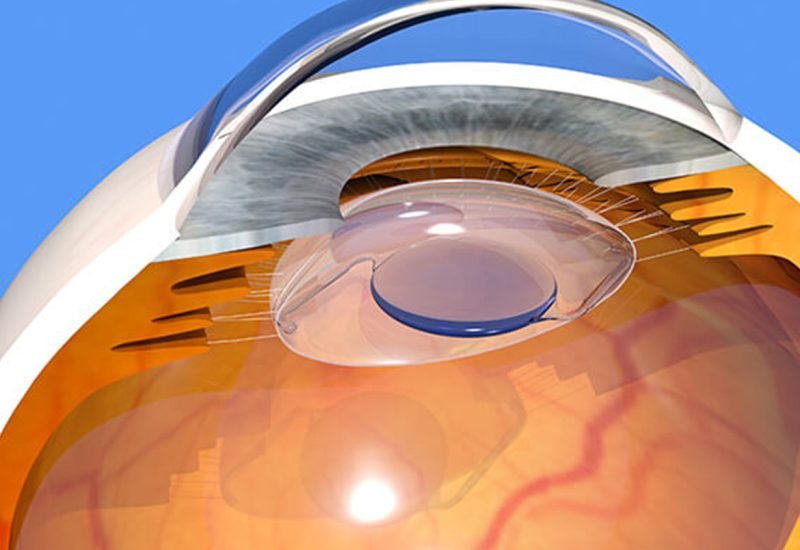 07 Refractive Lens Exchange