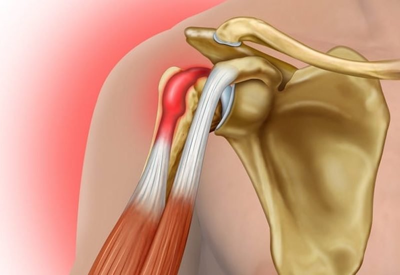 Biceps-Tendon-Surgery