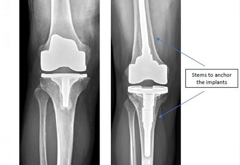 Complex-or-Revision-Knee-Replacement