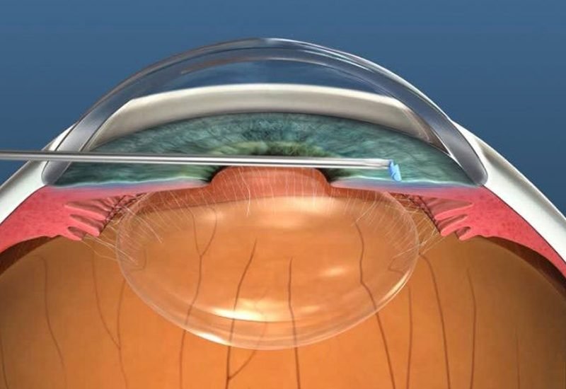 Femtosecond Laser-Assisted Cataract Surgery