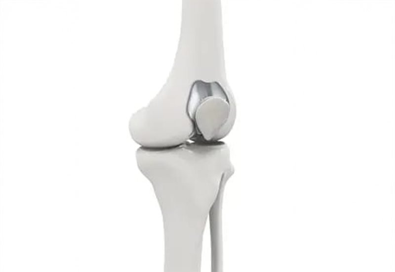 Kneecap-Replacement-(Patellofemoral-Arthroplasty)