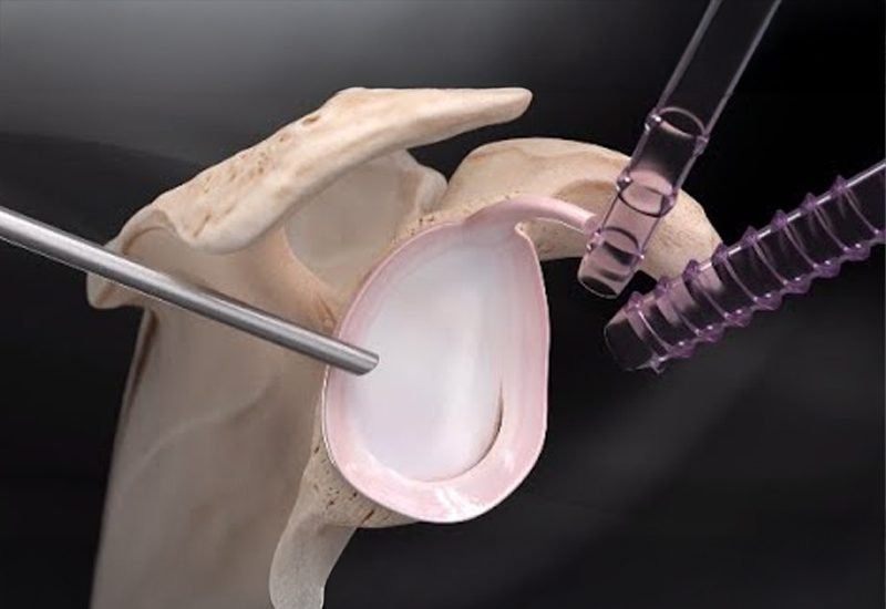 Labral-Repair-Surgery