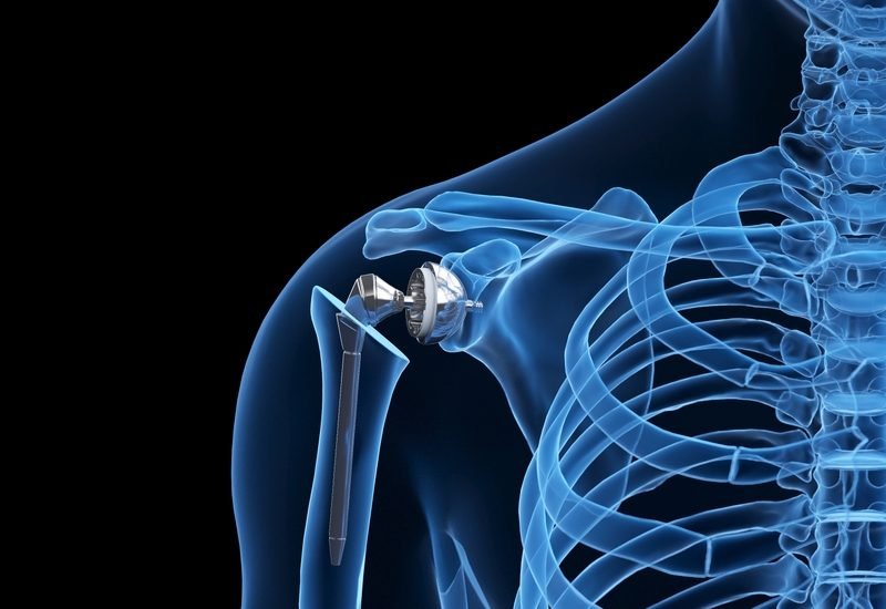 Shoulder-Replacement-Surgery