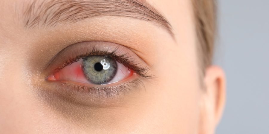 Woman,Suffering,From,Conjunctivitis,On,Grey,Background,,Closeup,Of,Red