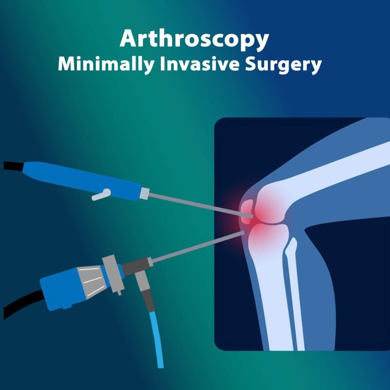What Is Arthroscopy