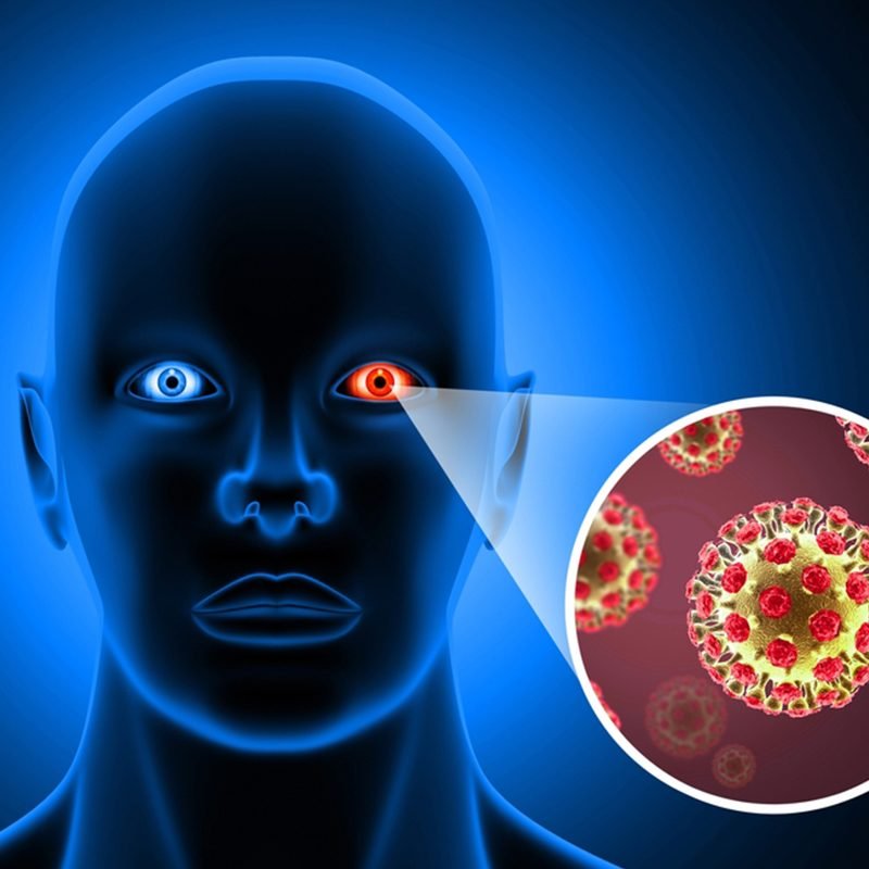 What is Conjunctivitis copy