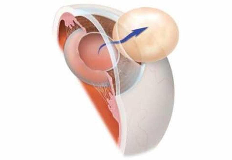 intracapsular cataract extraction